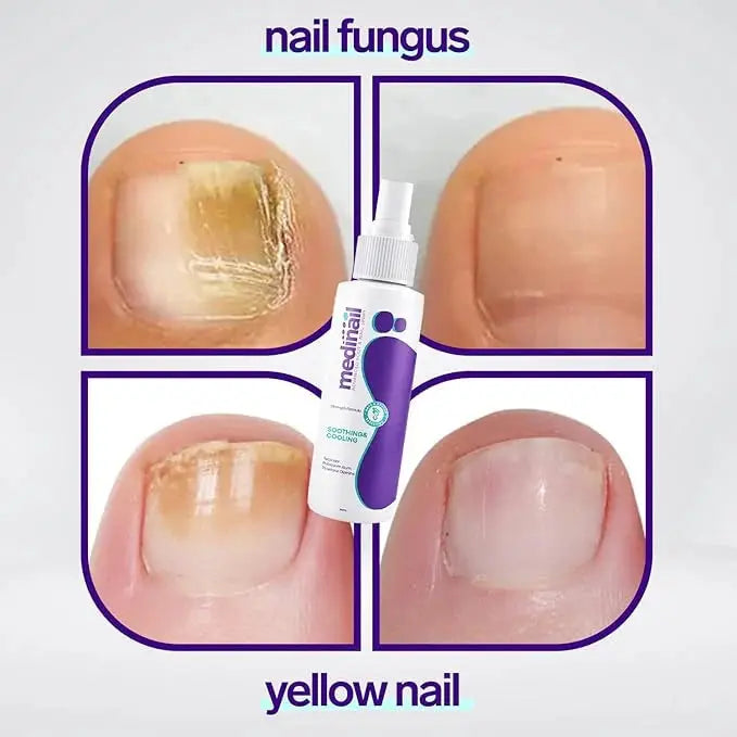 Jaysuin - Nail Fungus Spray Devour